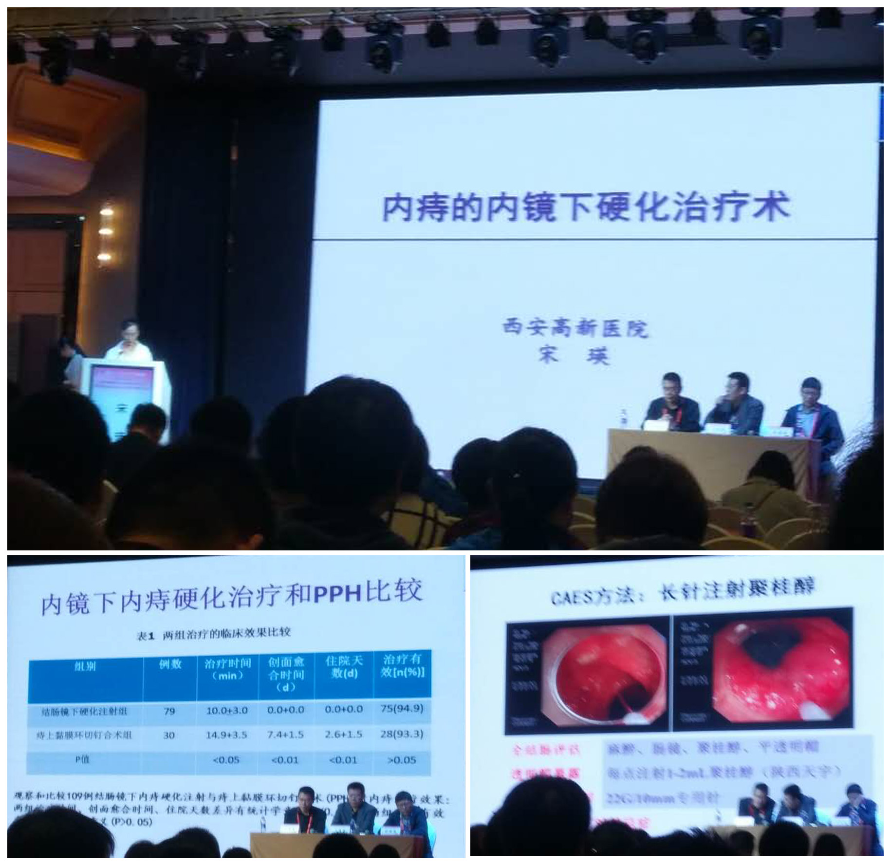 西安高新医院宋瑛副院长-内痔的内镜下硬化治疗技术